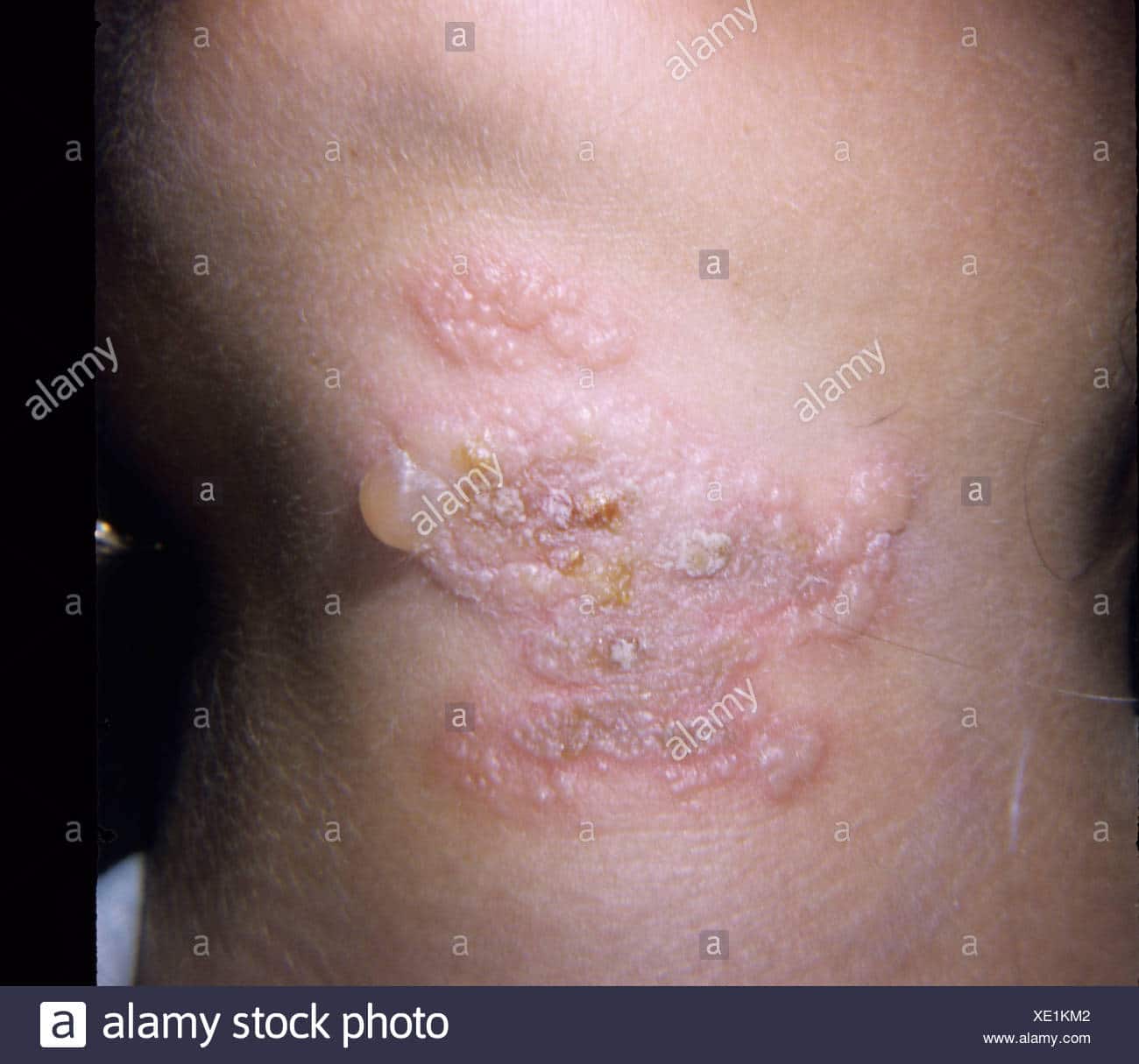Herpes simplex rash on the patient