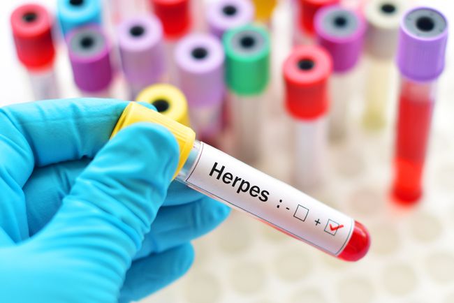 Herpes Simplex: The Hidden Disease