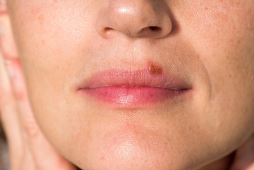 Herpes Simplex Virus â The Cause of Cold Sores