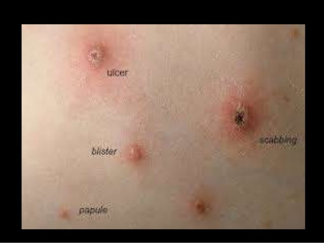 Herpes Simplex Virus (HSV) and Varicella Zoster Virus (VZV ...