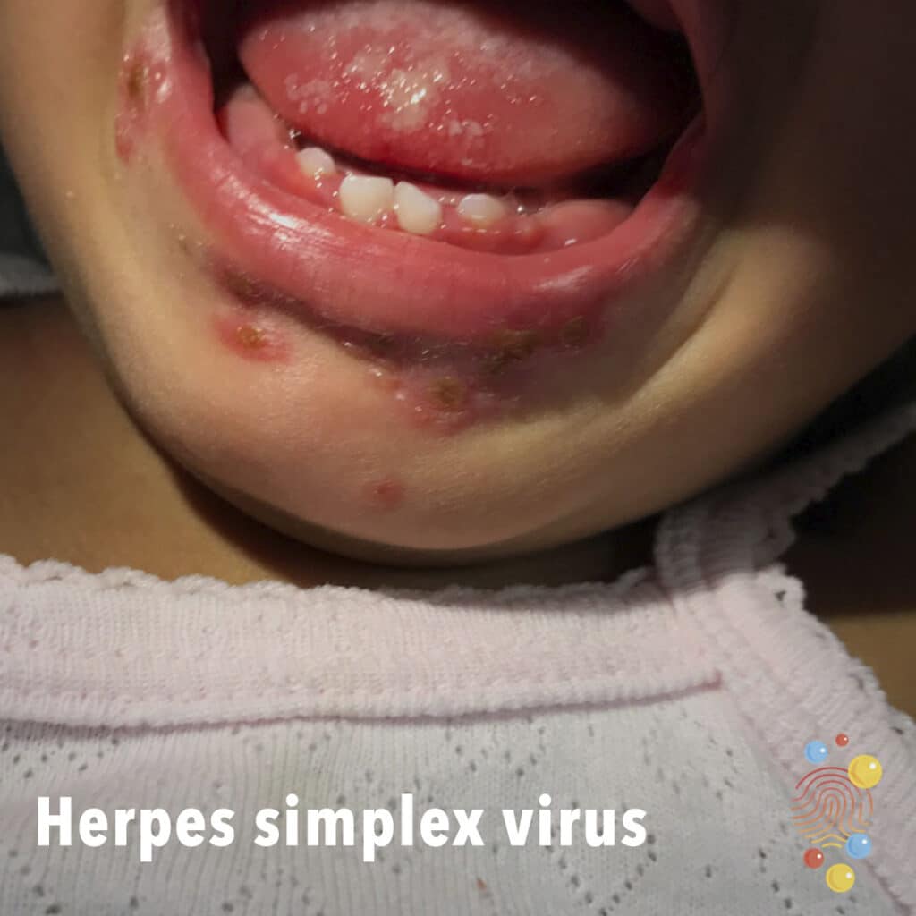 Herpes simplex virus