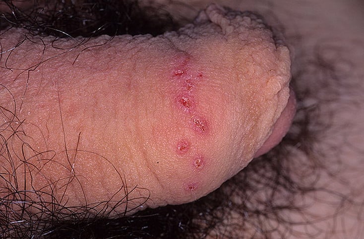Herpes Symptoms in Men Pictures  30 Photos &  Images / illnessee.com