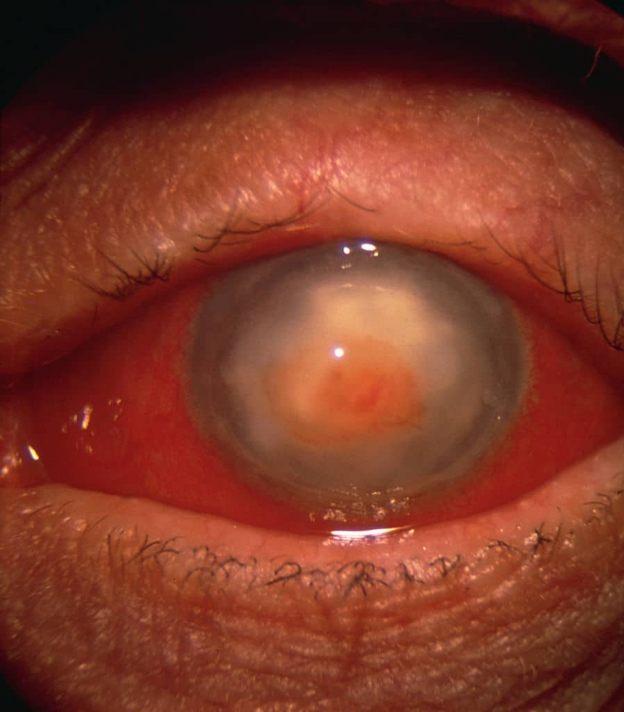 Herpes Symptoms In The Eyes You Should Not Ignore