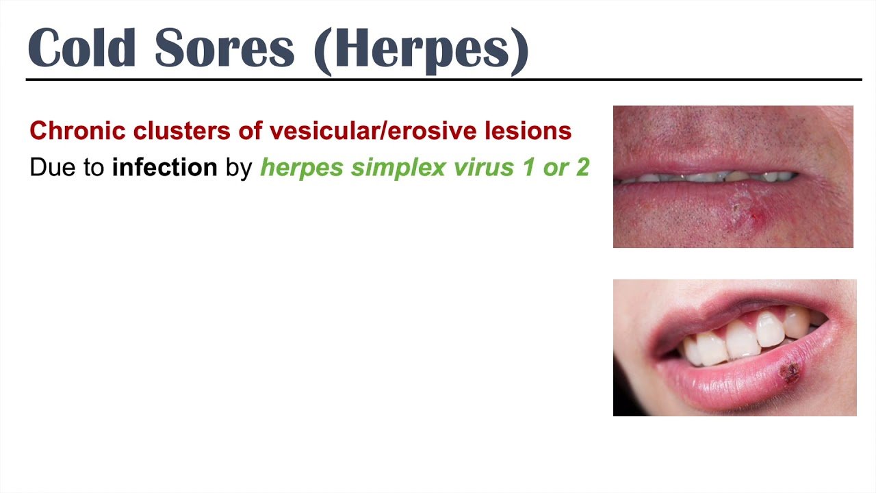 Herpes (Types and prevention) quick ways to get rid of Hsv 1& 2