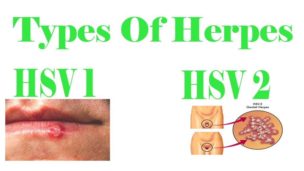 HERPES TYPES