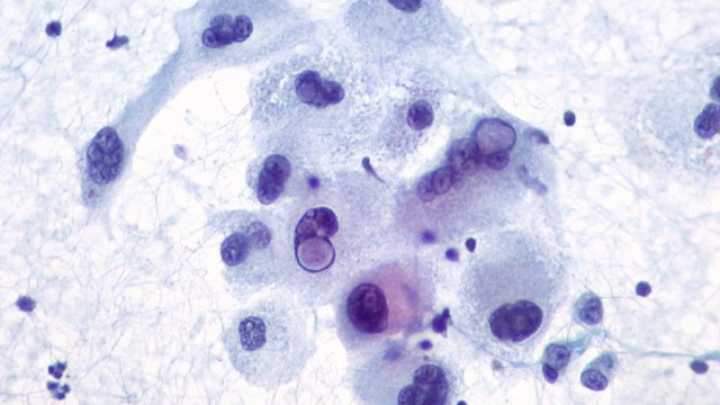 Herpes Virus Could Treat Skin Cancer