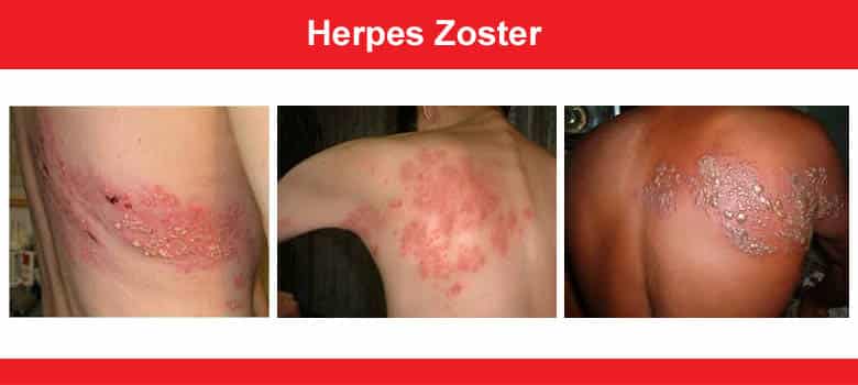 Herpes Zooster