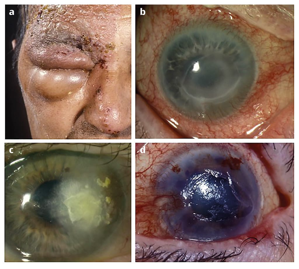 Herpes zoster ophthalmicus