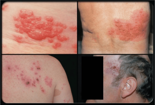Herpes zoster (shingles) rash.Notes: Herpes zoster (shi