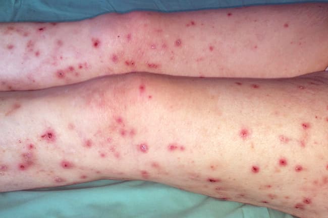 HIV and AIDS Rashes and Skin Conditions