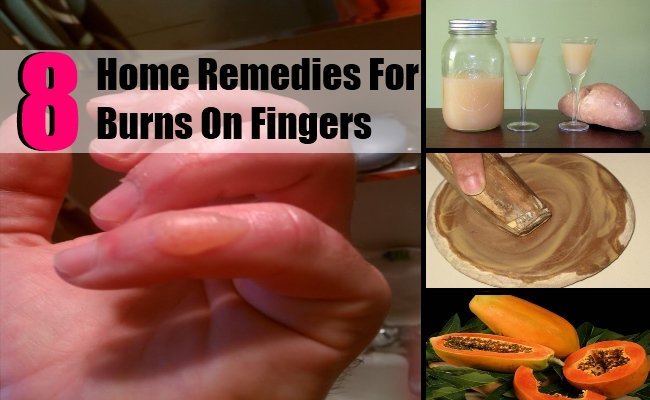 Home Remedies for Burns on Fingers