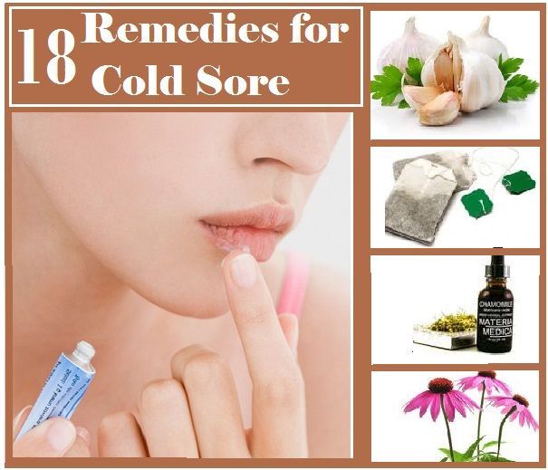Home Remedies for Cold Sore