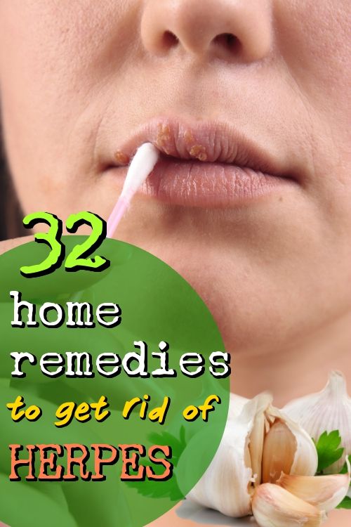 Home Remedies For Herpes