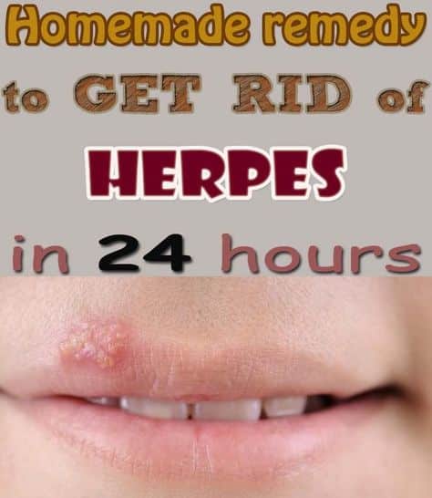 Homemade remedy to get rid of herpes in 24 hours