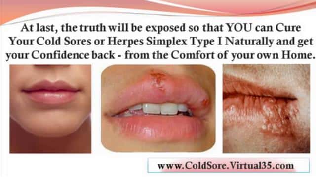How Long After Being Exposed To Herpes Do You Test Positive
