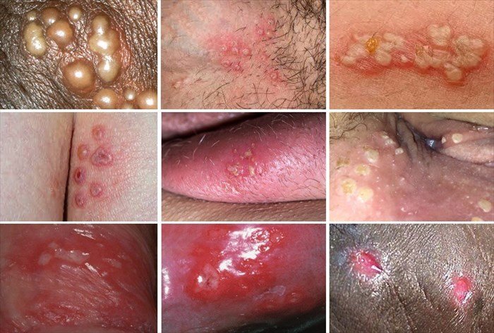 How Long Does a Genital Herpes Outbreak Last?