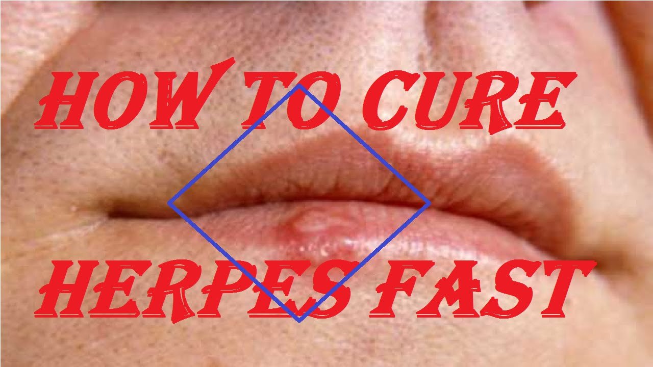 How To Cure Herpes Fast : How To Treat herpes