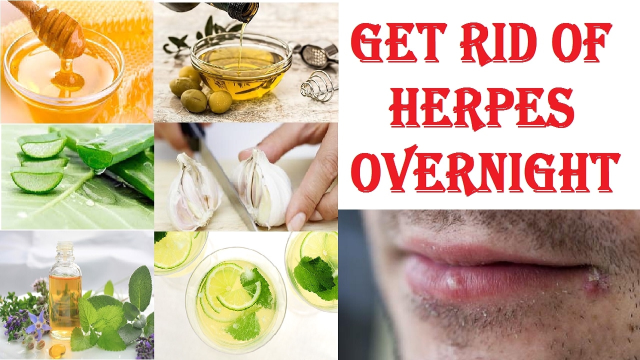 How To Cure Herpes Overnight