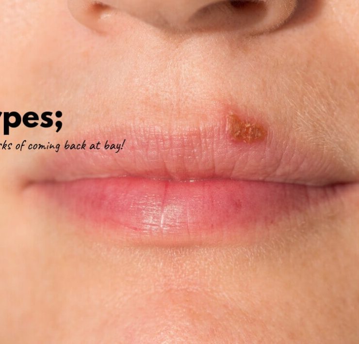How To Get Herpes To Stop Itching