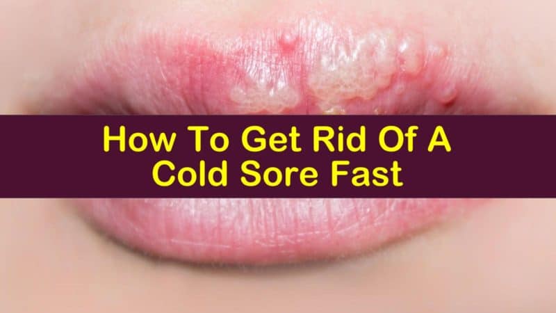 How To Get Rid Of A Cold Sore Fast
