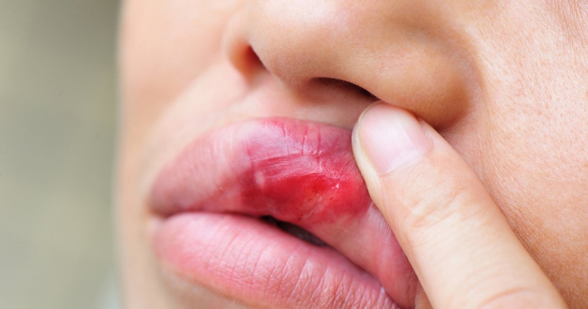 How to Get Rid of a Herpes Sore