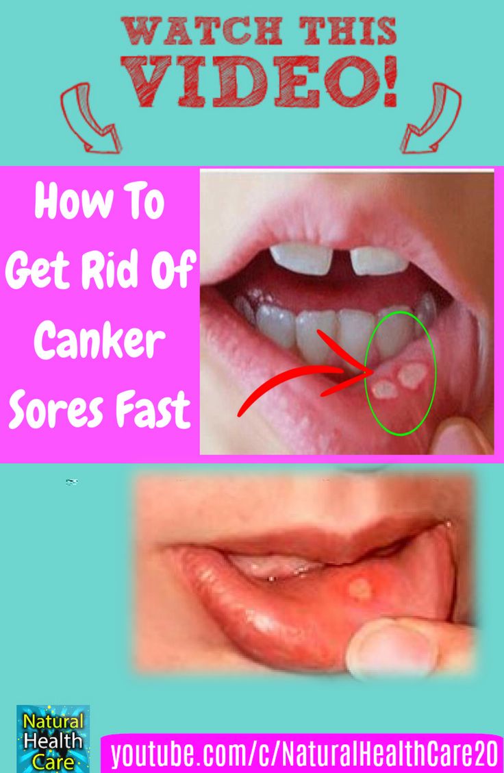 How to Get rid of Canker Sores Fast