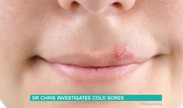 How to get rid of cold sore: Take a lysine supplement daily says Dr ...