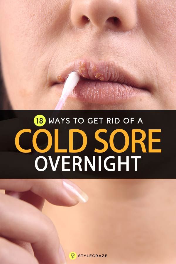 How To Get Rid Of Cold Sores â 20 Home Remedies And Other Treatments ...