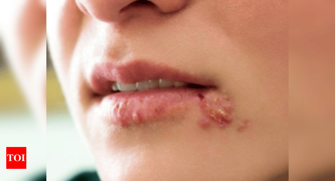 How To Get Rid Of Fever Blisters On Your Lip Fast
