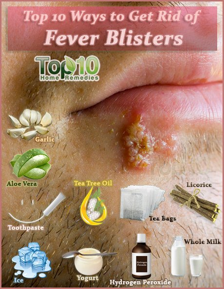 How to Get Rid of Fever Blisters
