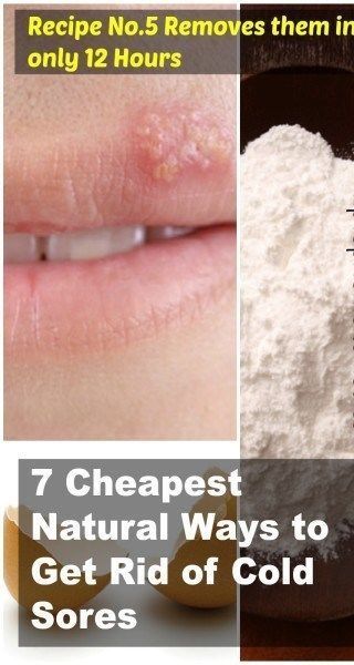 How To Get Rid Of Herpes On Mouth