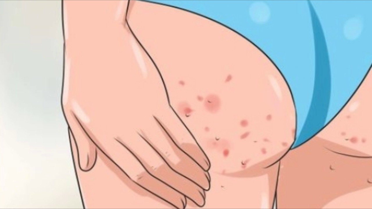 How to Get Rid of Rashes on Buttocks? by DuskySkin Experts