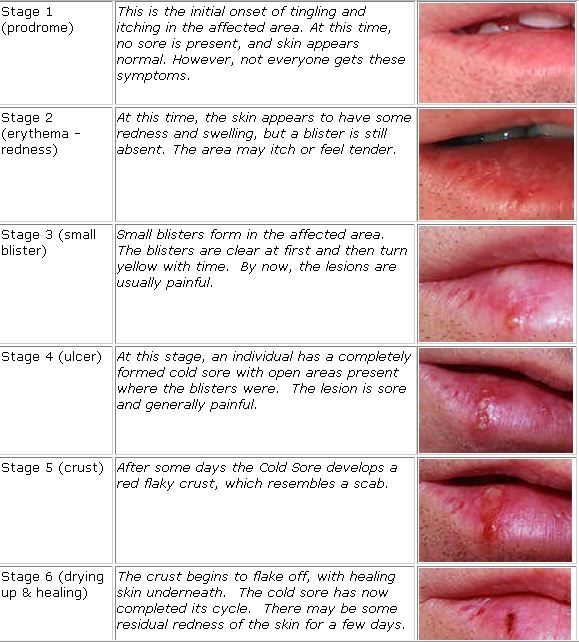 How To Heal Herpes Mouth Sores Faster