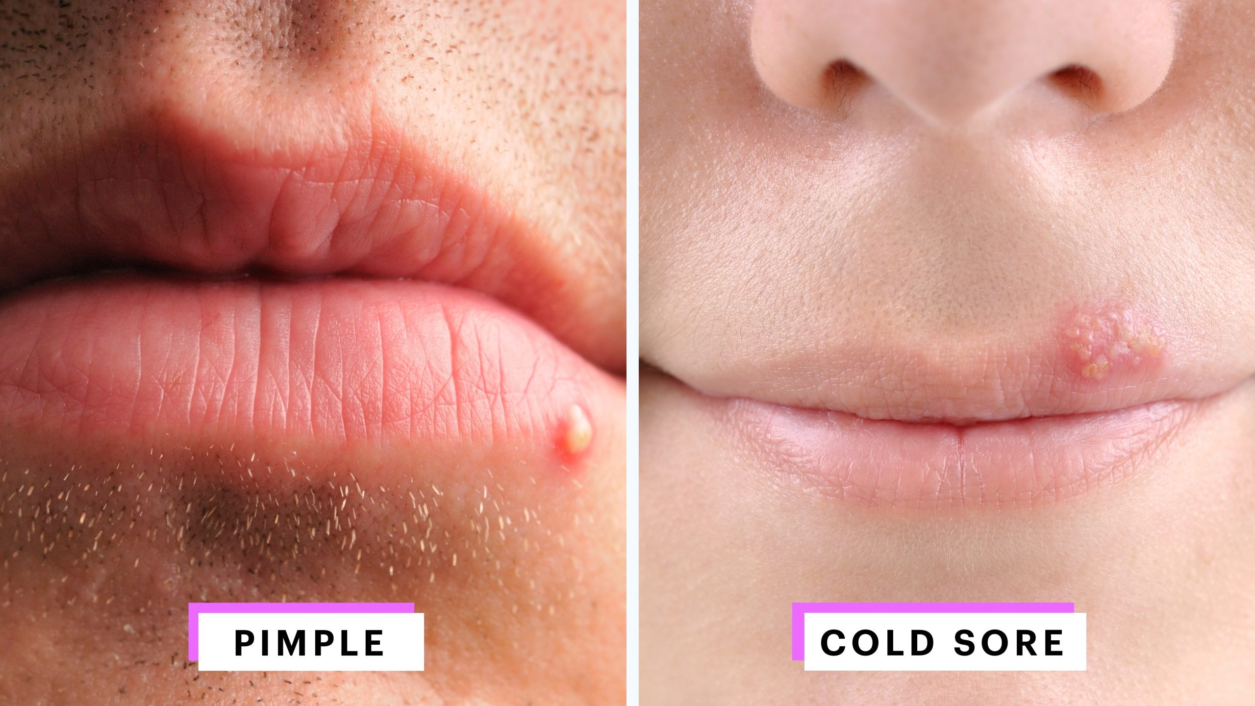 How to Identify a Herpes Cold Sore vs. Pimple