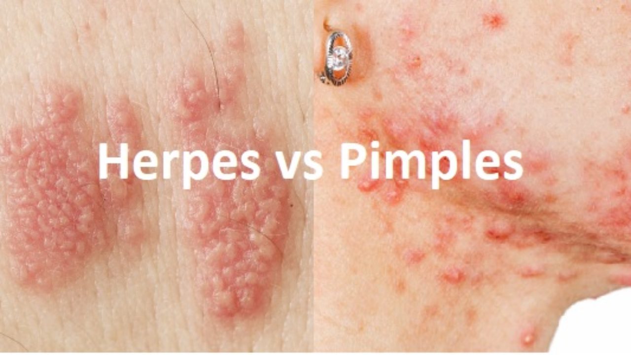 How to know if its herpes or a pimple