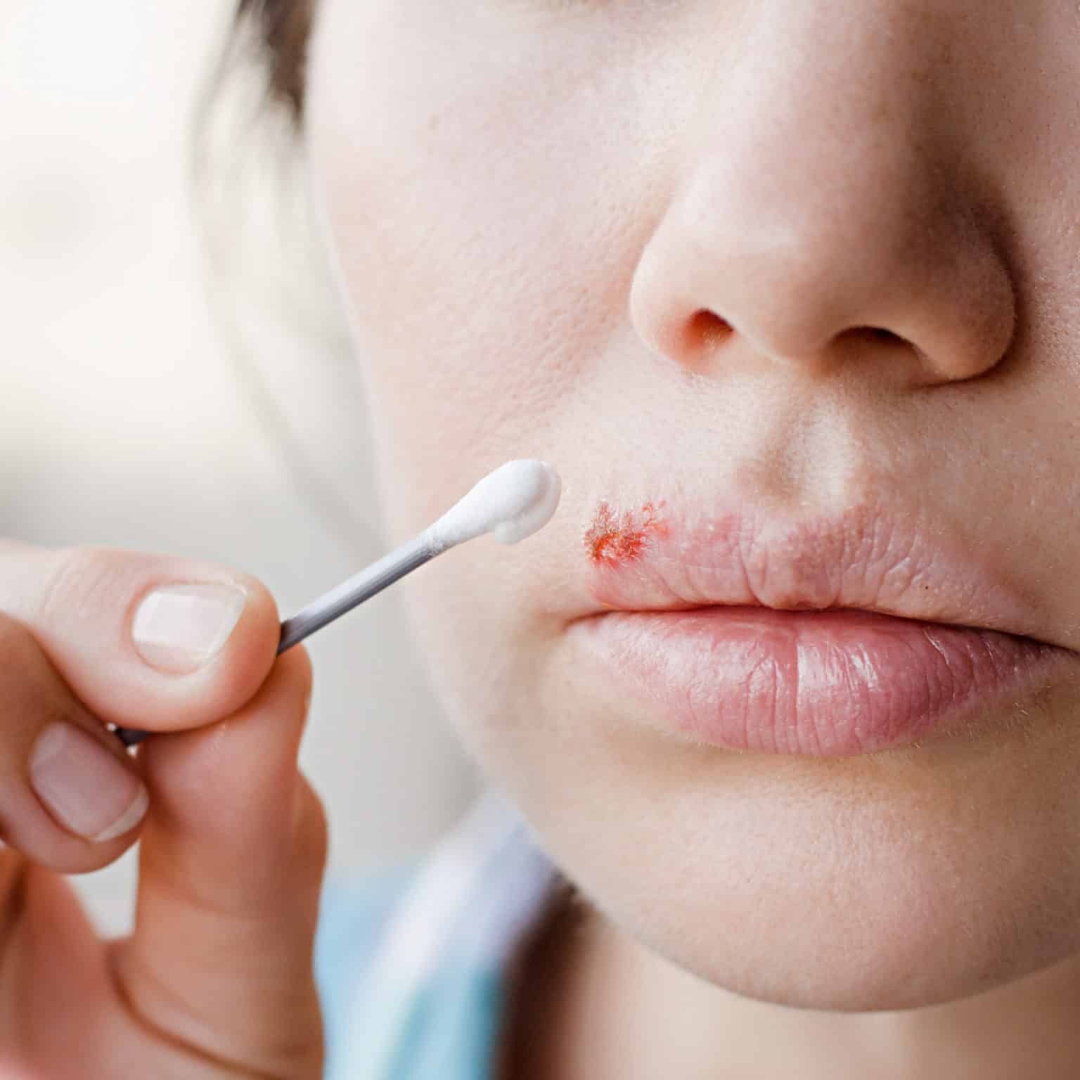 How to Quickly Get Rid of a Cold Sore