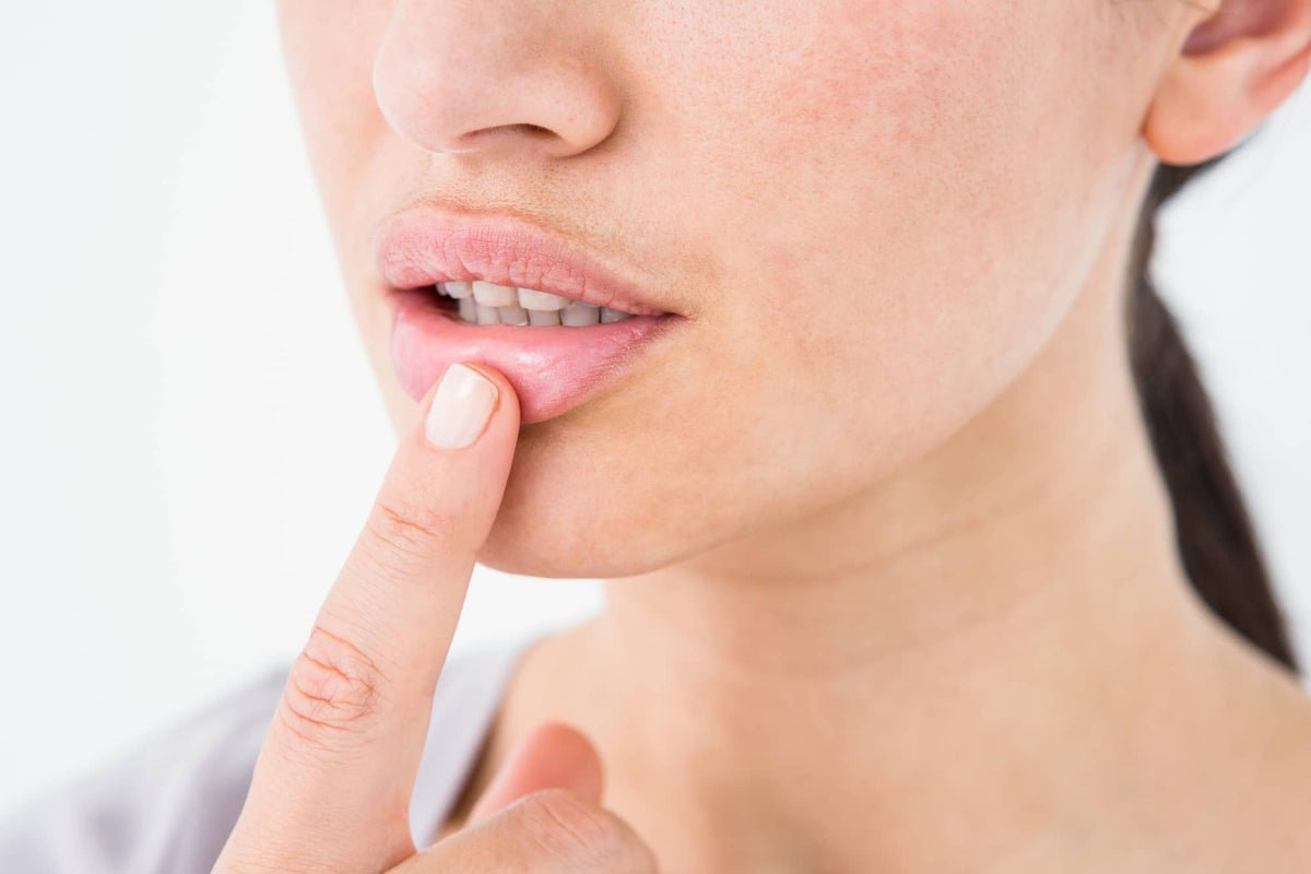 How to Reduce Cold Sore Swelling and Inflammation: The Complete Guide ...