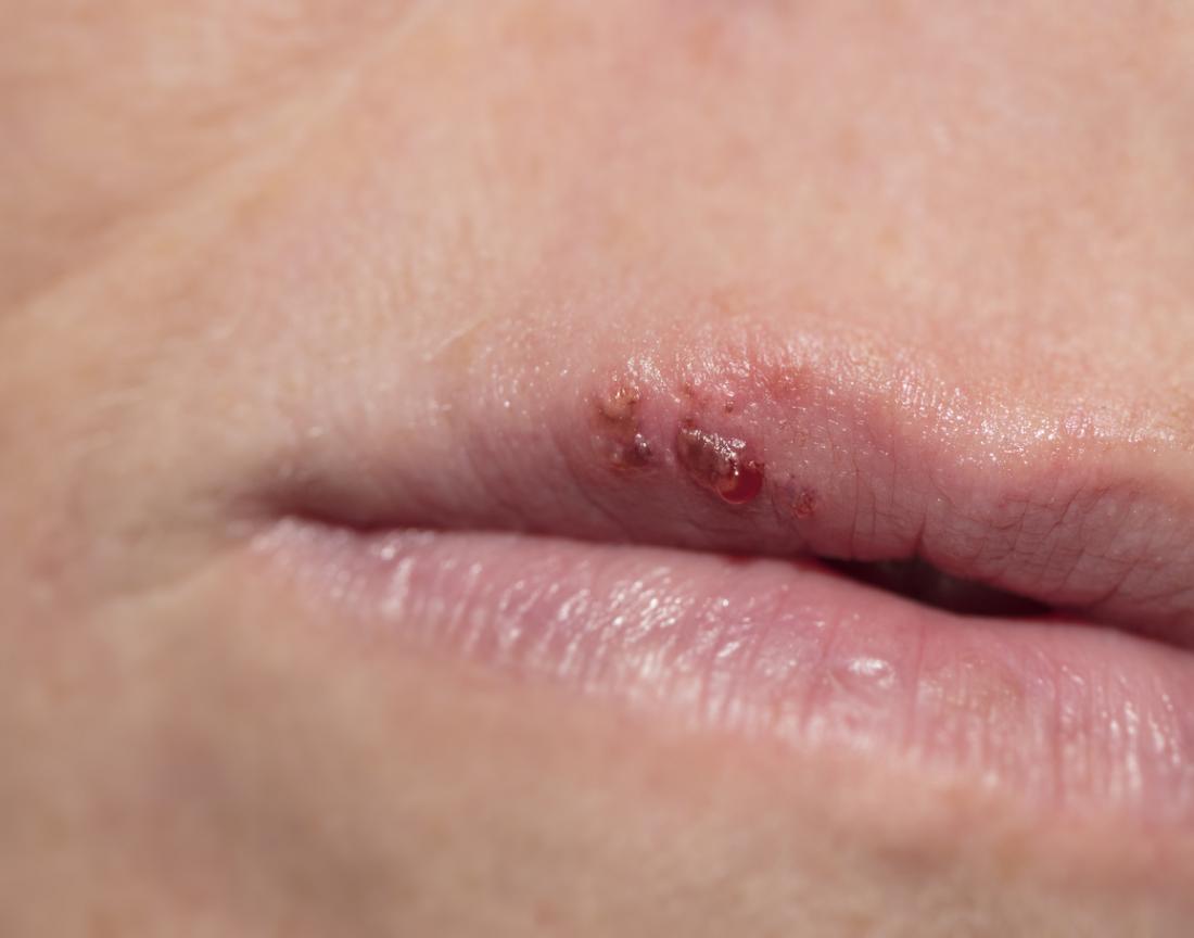 How to stop a cold sore in the early stages