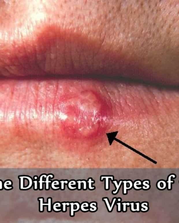 How to Tell the Difference Between Herpes and Pimples (With Photos ...