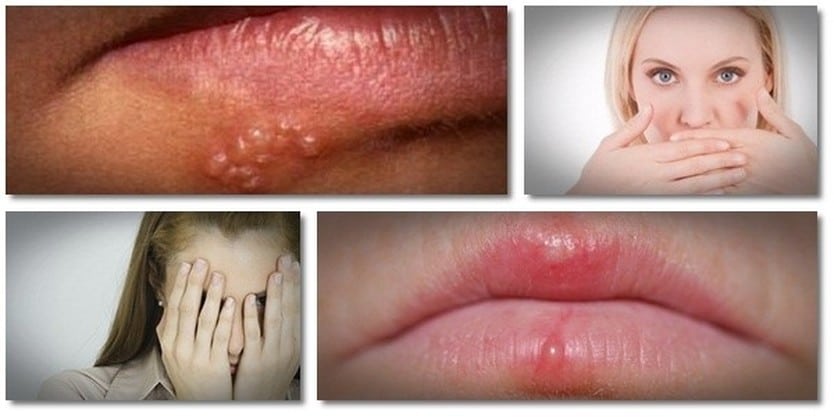 How to Treat Herpes Completely Naturally, Without Drugs