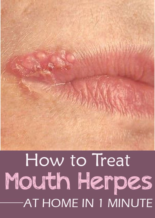 How to Treat Mouth Herpes at Home in 1 Minute