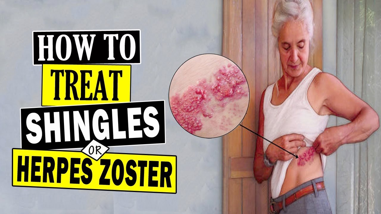 How to Treat Shingles at Home