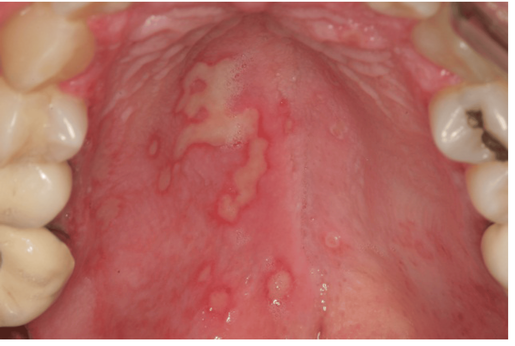 Hsv 1 On Tongue / Herpes Simplex Virus Blisters On The Tongue And Roof ...