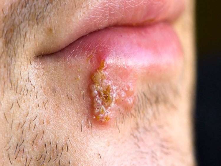 HSV 1 treatment in India
