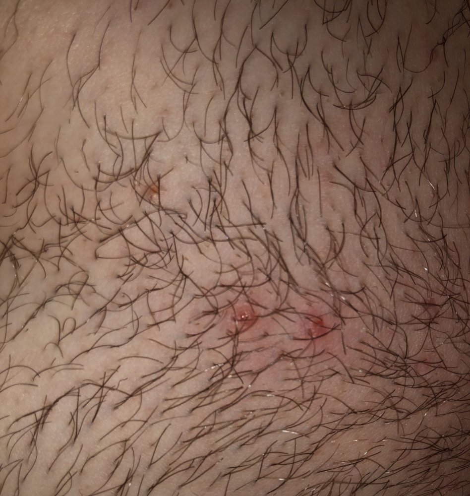 I cant tell if I have ingrown hairs, or symptoms of hpv warts ...