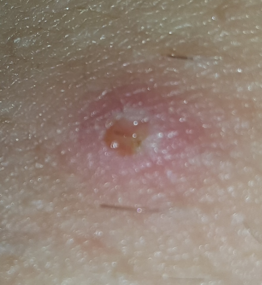 Infected/ingrown hairs or herpes..?