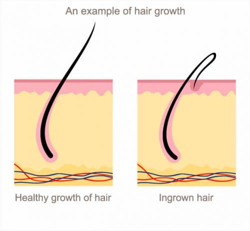 Ingrown Hair or Herpes