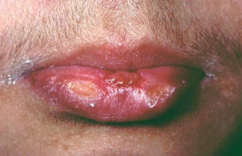Is Cold Sores Herpes