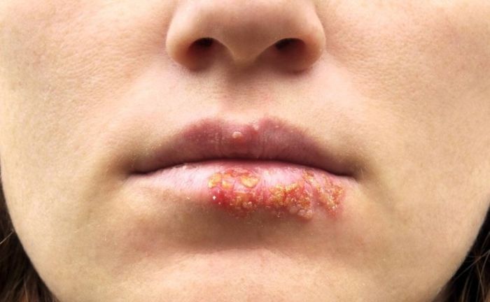 Is herpes curable if caught early