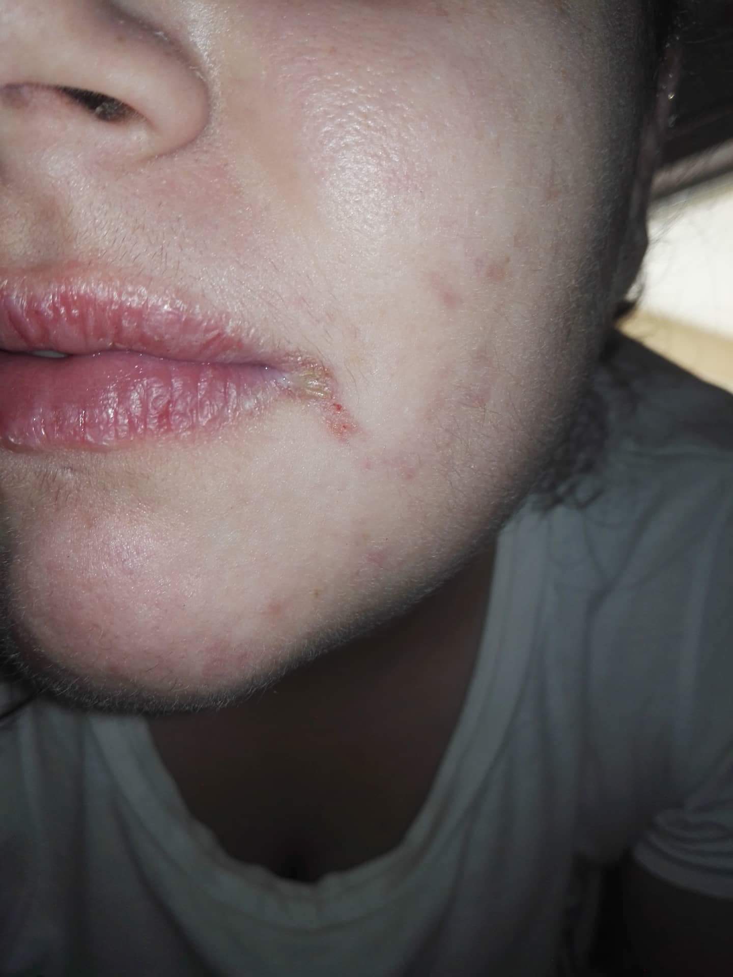 Is it an infection on the corner of my mouth? Or oral herpes? : Accutane